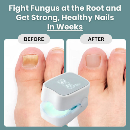Kuadora Pro™ - Nail Fungus Laser Device