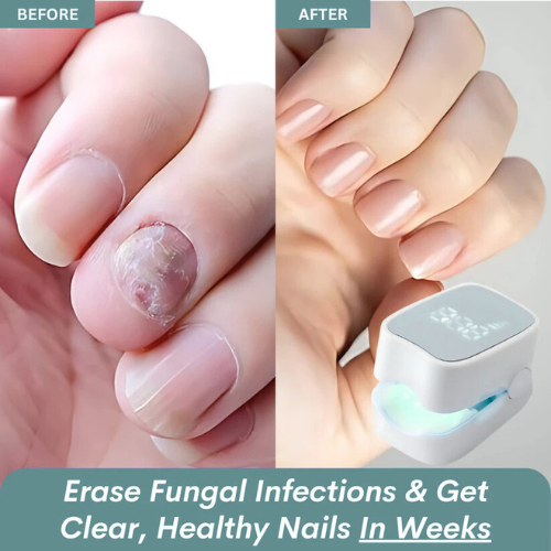 Kuadora Pro™ - Nail Fungus Laser Device