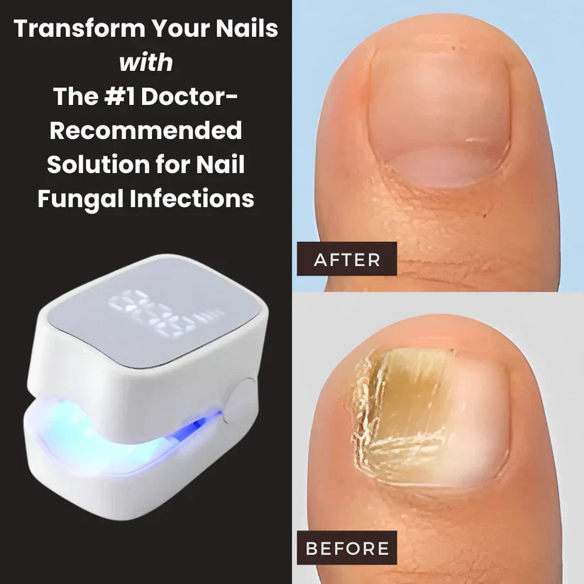 Kuadora Pro™ - Nail Fungus Laser Device