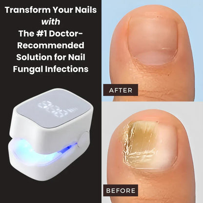 Kuadora Pro™ - Nail Fungus Laser Device